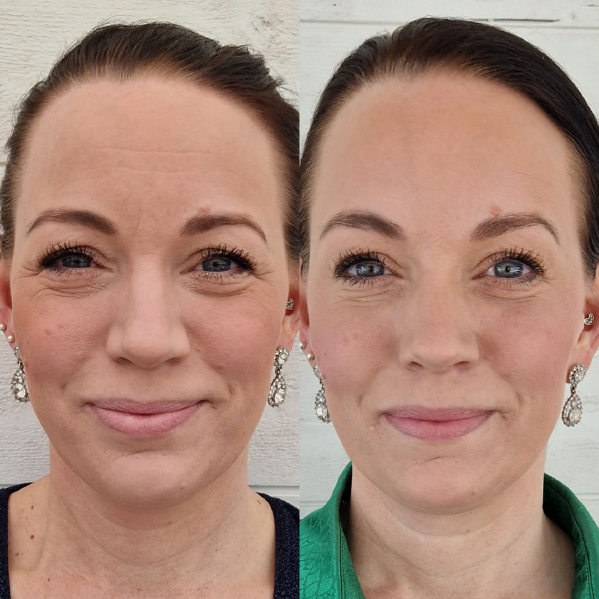 Före- och efterbild  botox upper face